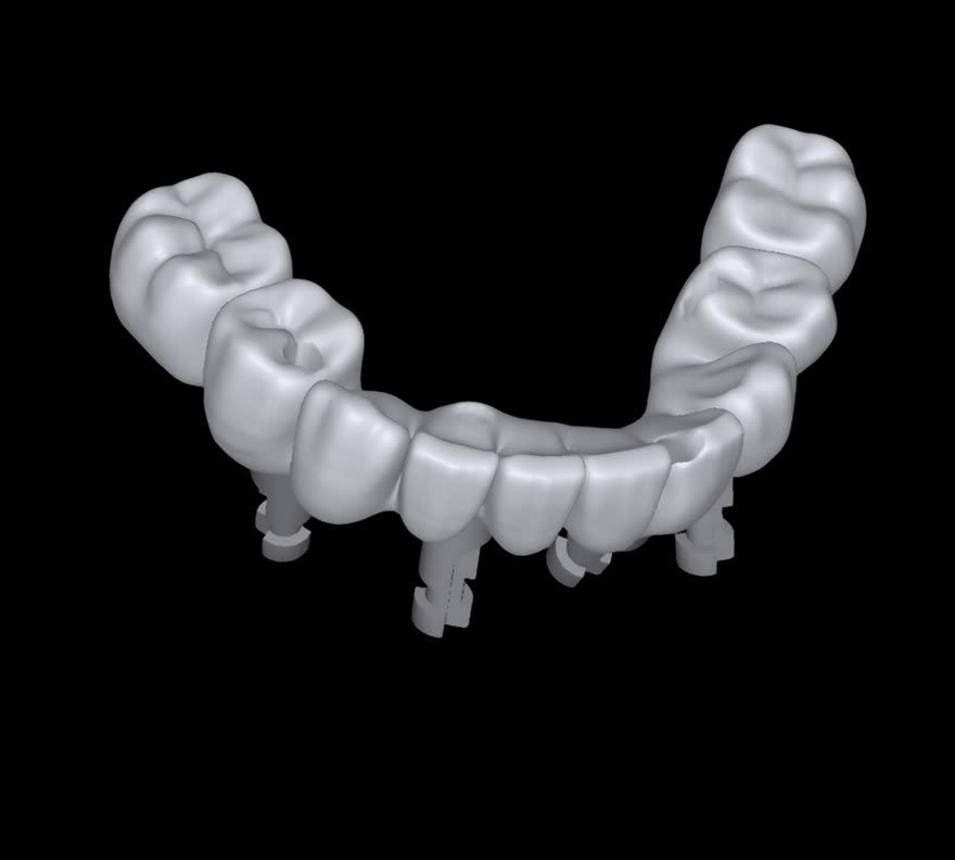 Three-unit implant bridge design