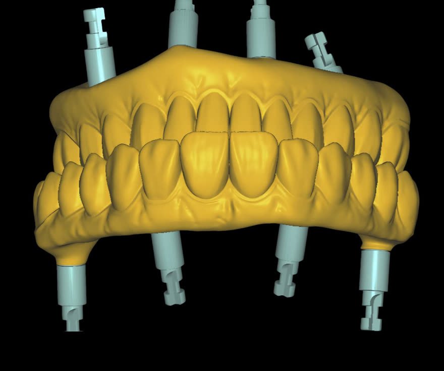 Full-arch implant case