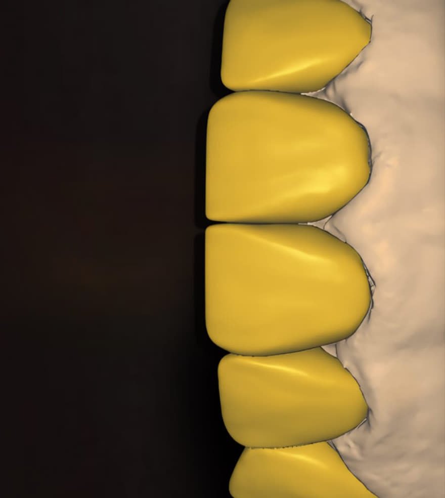 Anterior veneers design