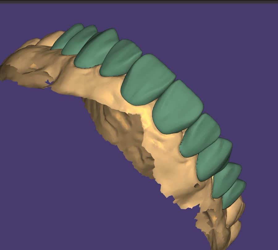 Exocad design by a Camp student