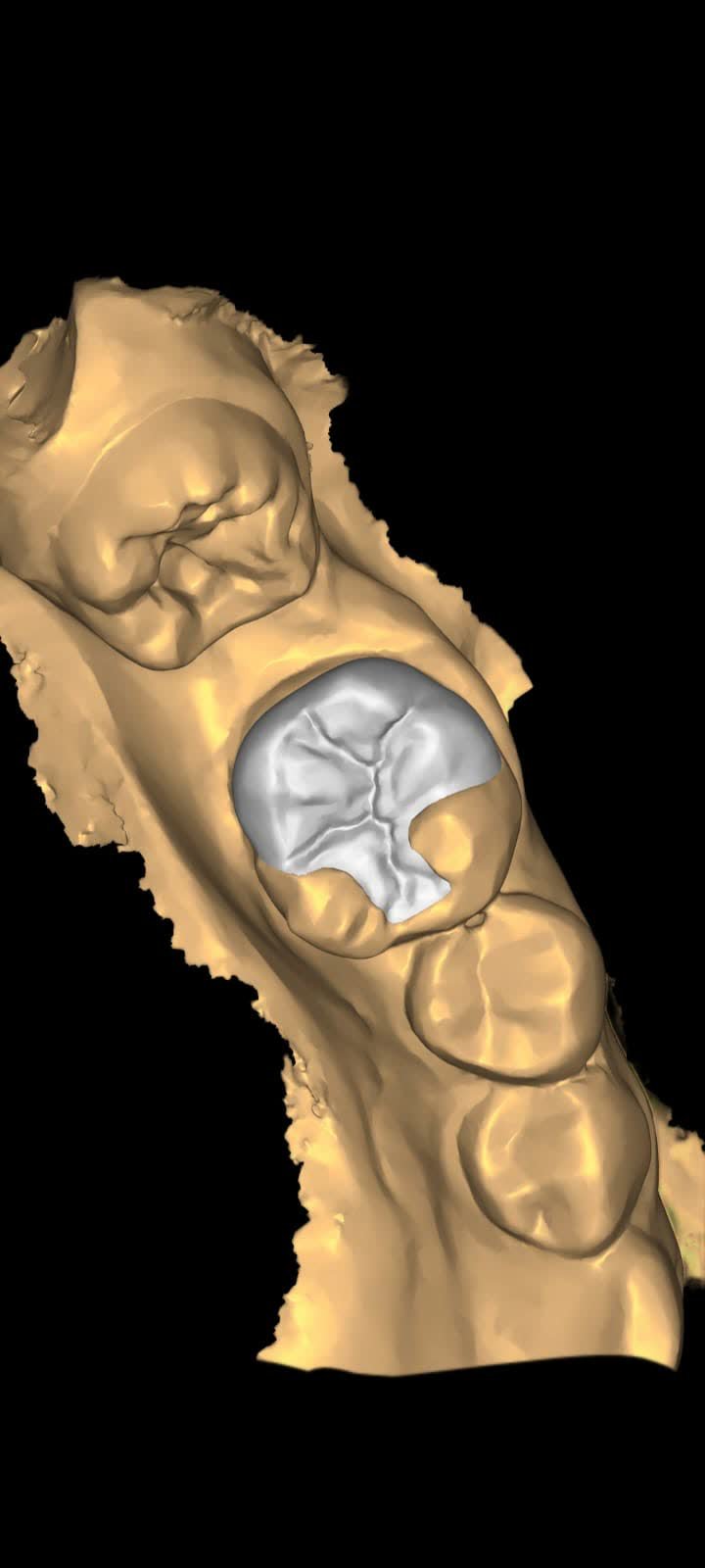 Exocad design by a Camp student